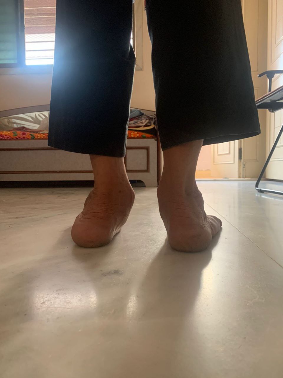 Severe Foot Pronation